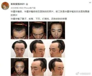 Hoa Thần Vũ bị bạn gái cũ quen 7 năm tố cấy tóc và phẫu thuật thẩm mỹ?